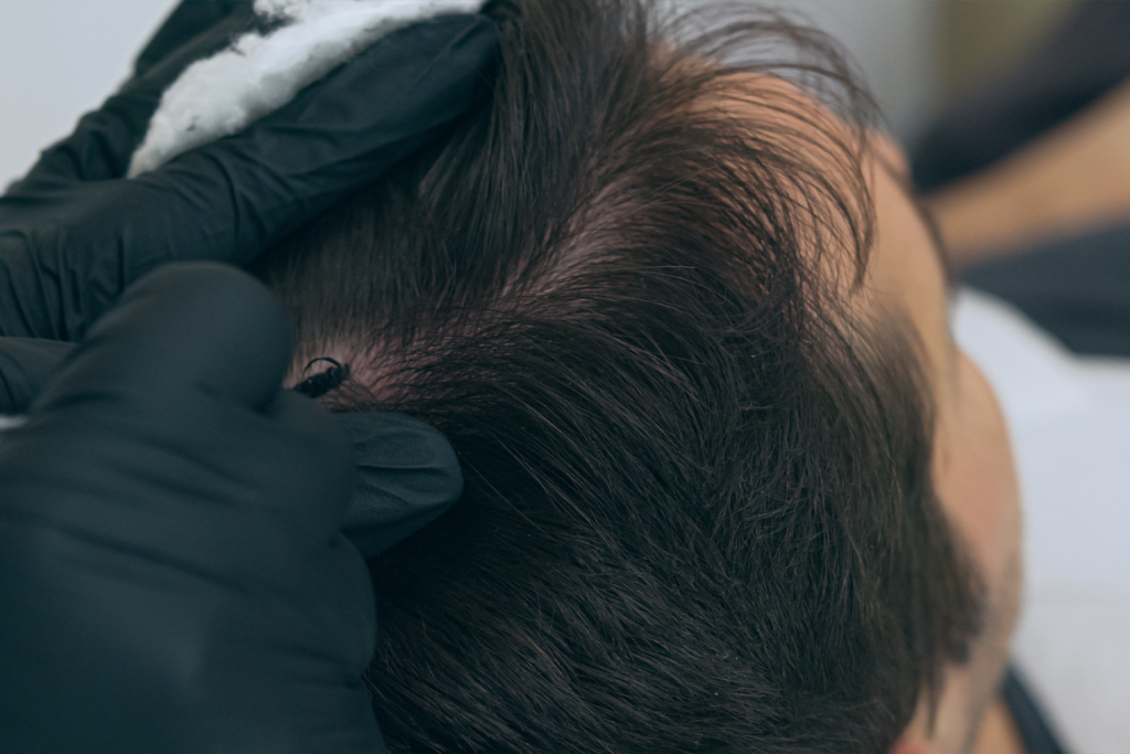 tricopigmentation zones clairsemées